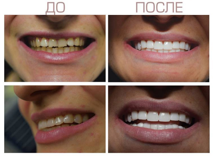 Композитная реставрация зубов: фото до и после - Стоматология АристократЪ-Дент